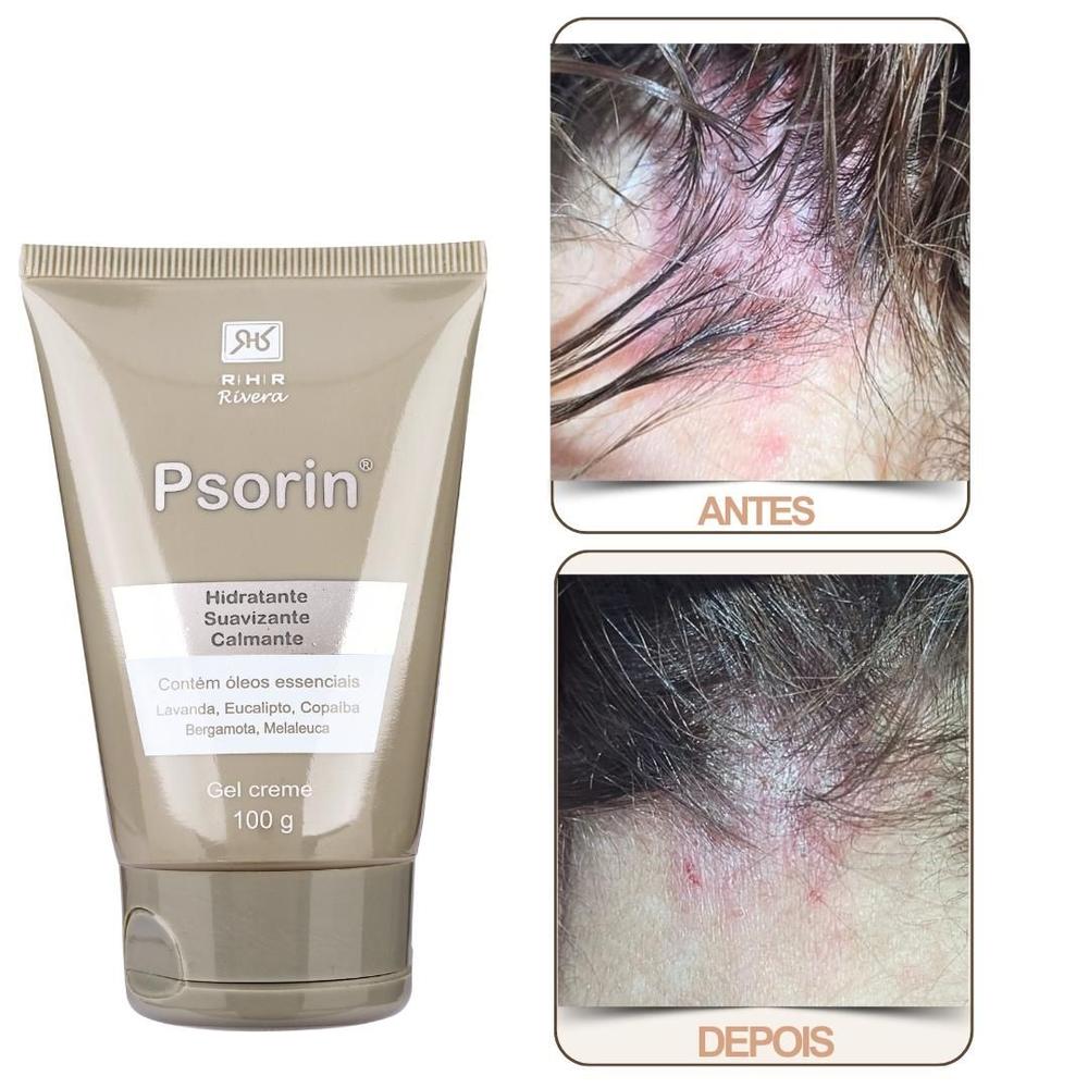 Creme para Psoríase  Psorin 100gr