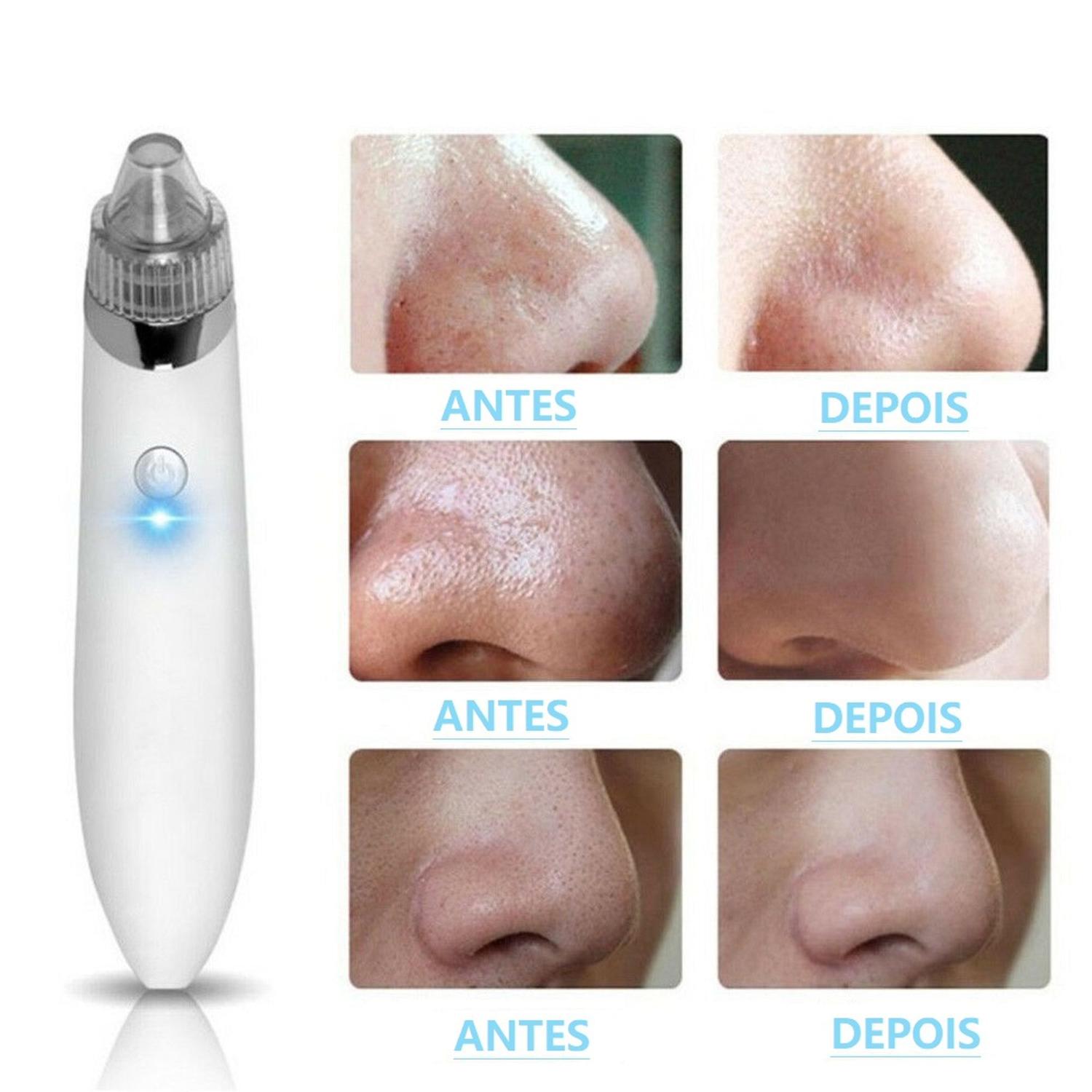 Imagem de Aparelho Dermoabrasão Sucção Removedor De Cravos E Espinhas Peeling Limpeza De Pele - Rosa