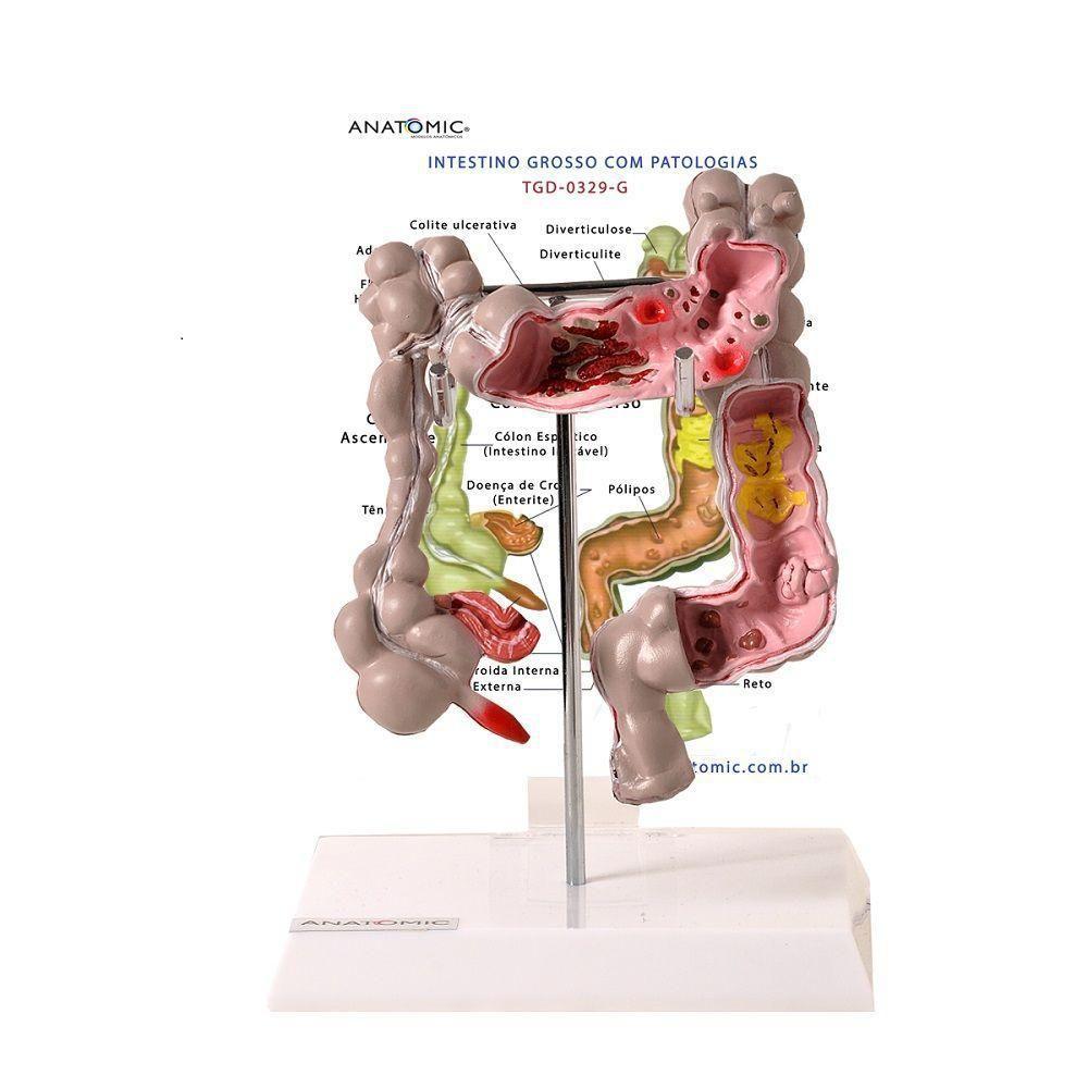 Anatomia Do Intestino Humano Digestive System Colon