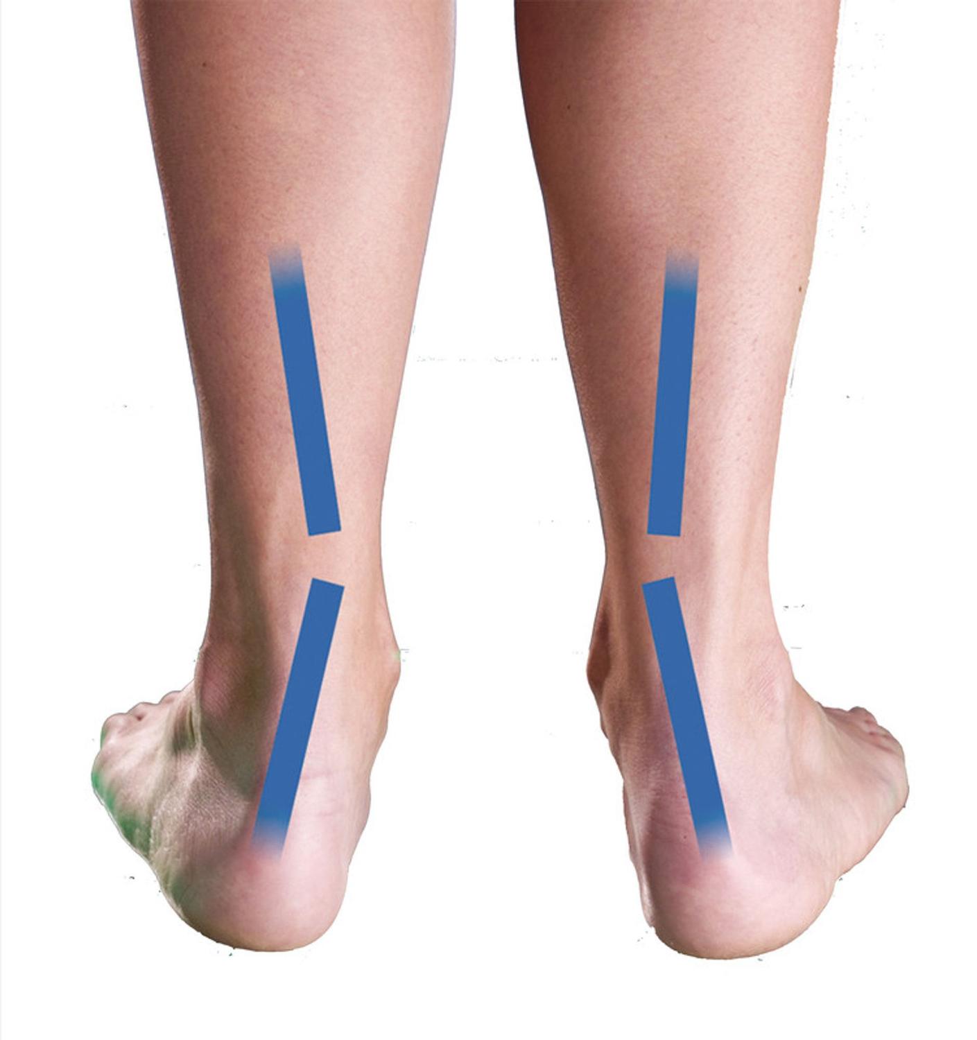 tênis pisada pronada