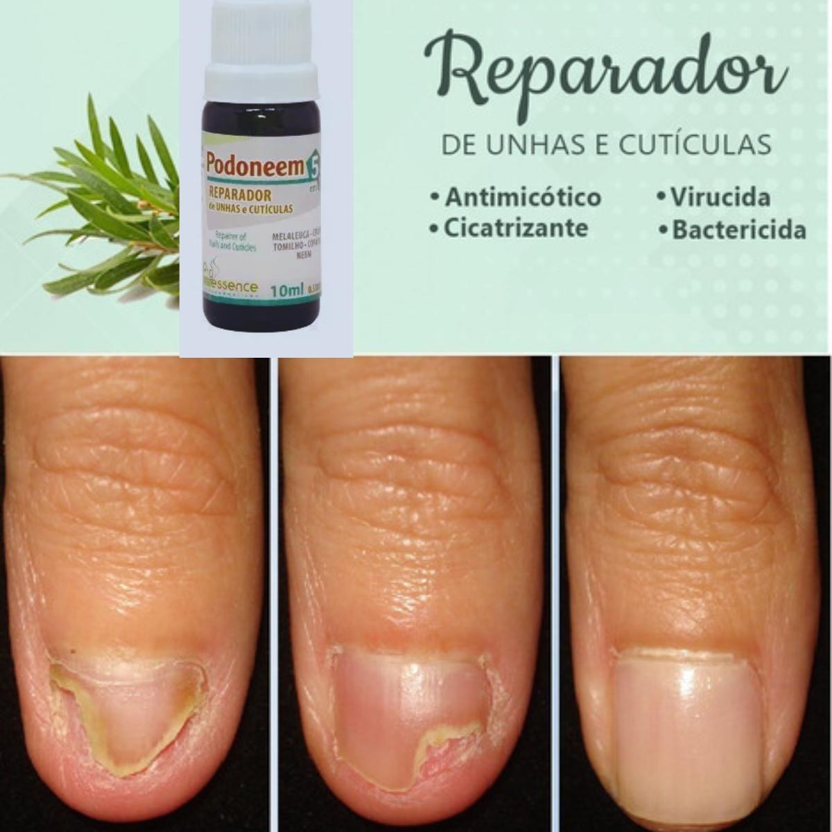 Tratamento De Micose