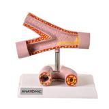 Artéria Saudável e Patológica Comparação - Anatomic