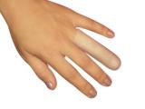 Dedeira Skingel M Sg-103 Orthopauher - Ortho pauher