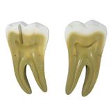 Dente Molar Ampliado Evolução da Cárie em 8 Parte - Anatomic