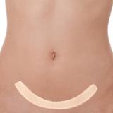 Fita Cirúrgica Abdominoplastia, Cesariana Côncava 70x3 cm - Siliforma