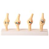 Joelho Saudável e Patológico Comparação - Anatomic