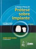 Livro - O Passo-a-Passo da Prótese Sobre Implantes - Da 2ª Etapa Cirúrgica à Reabilitação Final