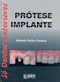 Livro - Prótese Sobre Implante - Só Dentes Anteriores