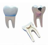 Modelo Anatômico Dente Molar Ampliado - Saudável e com Cáries - Anatomic