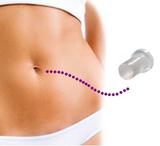 Órtese Conformador para Umbigo Cilíndrica Pós-Cirúrgica Silicone TM 601 - Tima