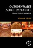 Overdentures Sobre Implantes - Manual Clínico e Laboratorial