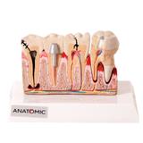 Patologia Dentária e Placa Explicativa em 2 Pts Modelo Anatomia - Anatomic