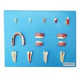 Placa com Doenças Dentárias 12 Peças Modelo Anatomia - Anatomic