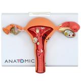 Útero c/ Trompas Patológico - Anatomic