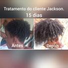 Calvície e queda de cabelo