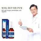 Como Recuperar Unha Com Micose Rapidamente - Use Spray De Iodo Antimicótico - Solução 30ml Forte
