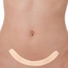 Fita para Cicatrizes de Abdominoplastia Côncava 50x3 cm - Siliforma