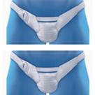 Kit 2 Suspensório Escrotal Pós Cicurgia Vasectomia Protetor Genital Operatório Testículo M