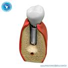 Macro Modelo Implante Cone Morse