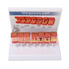 Modelo de anatomia arterial LUCKDANO 7PCS com trombo de aterosclerose Modelo de anatomia arterial LUCKDANO 7PCS com trombo de aterosclerose
