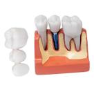 Modelo De Coroa Dentária Para Análise De Implante Removível