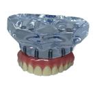 Modelo Superior Protocolo em Acrílico Maxila com 6 implantes