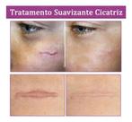 Pomada Creme Suavizante Tratamento De Cicatriz 20g DermaTriz.