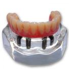 Protocolo Inferior com 4 Implantes