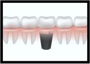 Quadro Decorativo Dentista Consultórios Odontológicos Dentes Implantes Com Moldura RC022 Quadro Decorativo Dentista Consultórios Odontológicos Dentes Implantes Com Moldura RC022