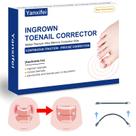 Tratamento domiciliar com corretor de unhas encravadas Yanxifei Nitinol Tratamento domiciliar com corretor de unhas encravadas Yanxifei Nitinol