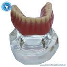 Macro Modelo Mandíbula Overdenture Acrílica com 2 ORings e Prótese Inferior