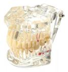 Manequim Modelo Dentário Ortodontia Dente Implante