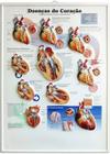 Pôster 3D Doenças do Coração em Alto-Relevo.
