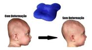 Travesseiro Plagiocefalia Cabeça Amassada Do Bebê