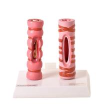 Brônquio Saudável e Patológico Comparação