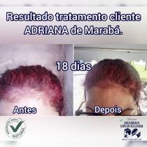 Calvície e queda de cabelo