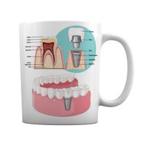Caneca Branca Dentista Prótese Dentária Implante Dentário