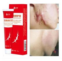 Creme Para Remover Cicatrizes Vm - JINGSHENG