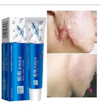 Creme Para Remover Queloide Cicatriz Suai 20g