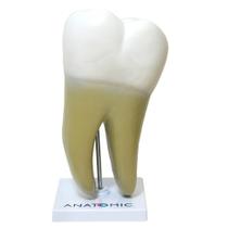 Dente Molar Ampliado Saudável e Cárie Modelo Anatomia