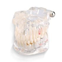 Dentes dentários modelo Yosoo Health Gear Dentário para Implante Dentário