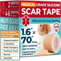 Fita de Silicone para Cicatrizes MYHELP 4x178 cm Reutilizável Grau Médico
