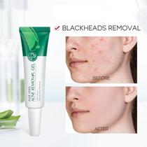 Gel de Aloe Vera para Suavizar Marcas de Espinhas Antigas Gel de Aloe Vera para Suavizar Marcas de Espinhas Antigas