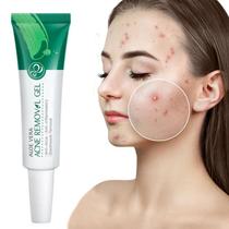 Gel para Aliviar Sensação de Queimação no Rosto com Babosa