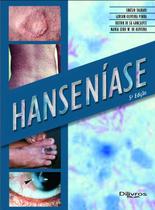 HANSENIASE, Autor: SINESIO TALHARI GERSON O PENNA HEITOR DE SA GONCALVES MARIA LEIDE W DE OLIVEIRA HANSENIASE, Autor: SINESIO TALHARI GERSON O PENNA HEITOR DE SA GONCALVES MARIA LEIDE W DE OLIVEIRA