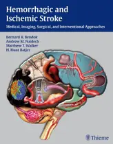 Hemorrhagic and ischemic stroke - THIEME MEDICAL PUBLISHERS/MAPLE PRESS Hemorrhagic and ischemic stroke - THIEME MEDICAL PUBLISHERS/MAPLE PRESS