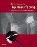 Hip resurfacing principles indications technique