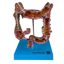 Intestino Grosso Humano com Patologia, Anatomia