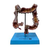 Intestino Grosso Humano com Patologia, Anatomia