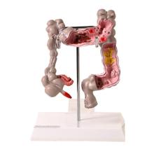 Intestino Grosso Humano Com Patologia, Anatomia
